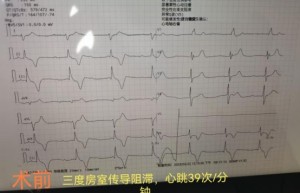 生命续航：简阳市中医医院成功完成首例临时起搏器植入术